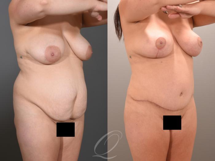 Tummy Tuck Case 1001653 Before & After Right Oblique | Serving Rochester, Syracuse & Buffalo, NY | Quatela Center for Plastic Surgery