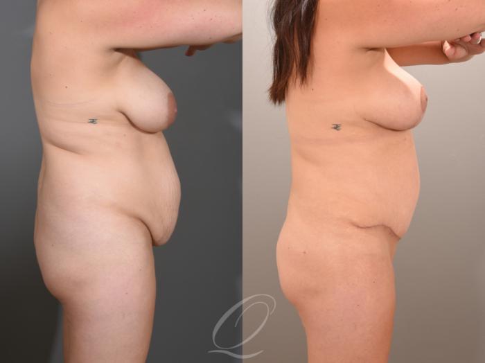 Tummy Tuck Case 1001653 Before & After Right Side | Serving Rochester, Syracuse & Buffalo, NY | Quatela Center for Plastic Surgery