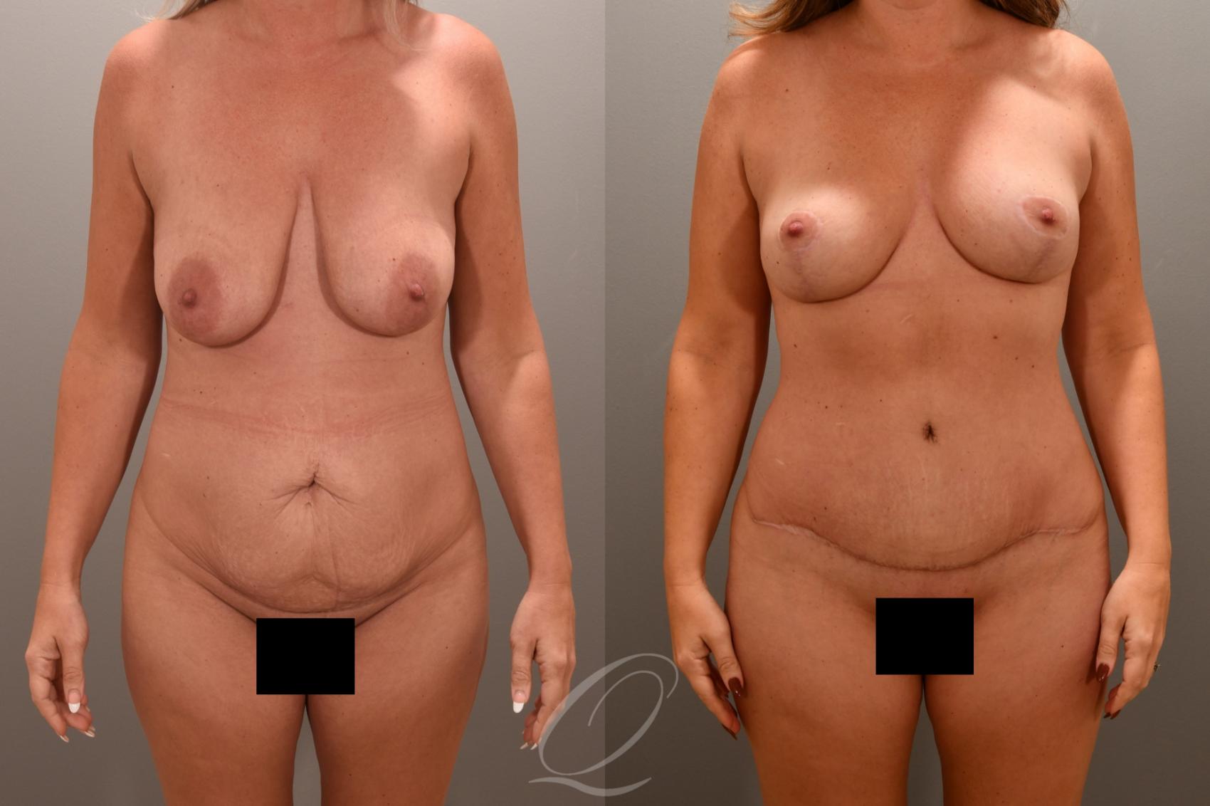 Mommy Makeover Case 1001721 Before & After Front | Serving Rochester, Syracuse & Buffalo, NY | Quatela Center for Plastic Surgery