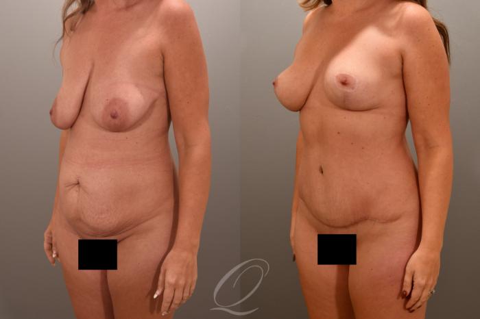 Mommy Makeover Case 1001721 Before & After Left Oblique | Serving Rochester, Syracuse & Buffalo, NY | Quatela Center for Plastic Surgery