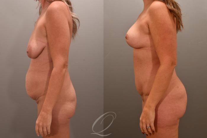 Tummy Tuck Case 1001721 Before & After Left Side | Serving Rochester, Syracuse & Buffalo, NY | Quatela Center for Plastic Surgery