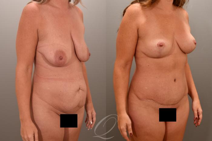 Breast Lift Case 1001721 Before & After Right Oblique | Serving Rochester, Syracuse & Buffalo, NY | Quatela Center for Plastic Surgery