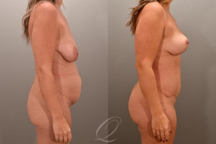 Mommy Makeover Case 1001721 Before & After Right Side | Serving Rochester, Syracuse & Buffalo, NY | Quatela Center for Plastic Surgery