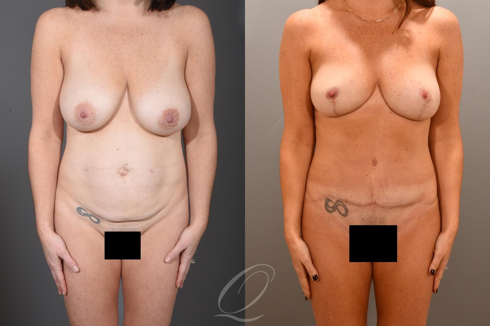 Tummy Tuck Case 1001722 Before & After Front | Serving Rochester, Syracuse & Buffalo, NY | Quatela Center for Plastic Surgery