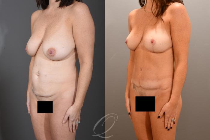 Mommy Makeover Case 1001722 Before & After Left Oblique | Serving Rochester, Syracuse & Buffalo, NY | Quatela Center for Plastic Surgery