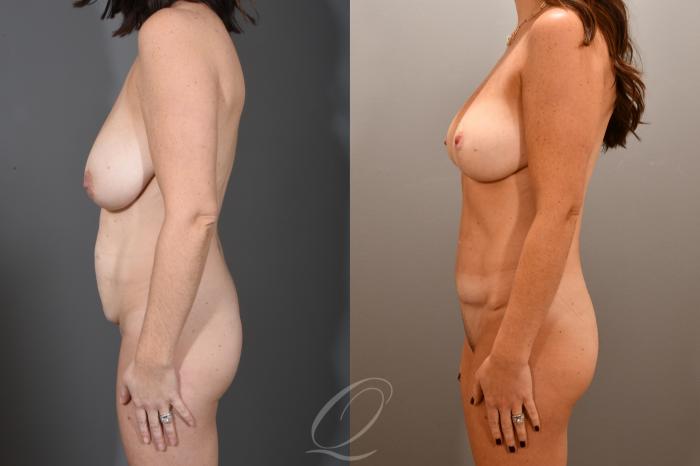 Tummy Tuck Case 1001722 Before & After Left Side | Serving Rochester, Syracuse & Buffalo, NY | Quatela Center for Plastic Surgery