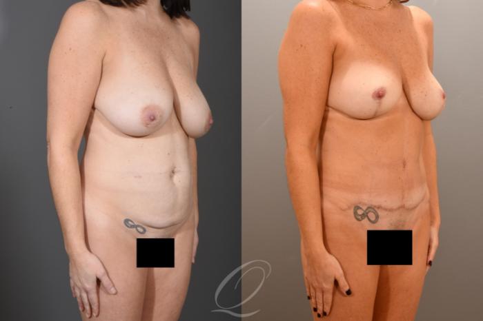 Mommy Makeover Case 1001722 Before & After Right Oblique | Serving Rochester, Syracuse & Buffalo, NY | Quatela Center for Plastic Surgery