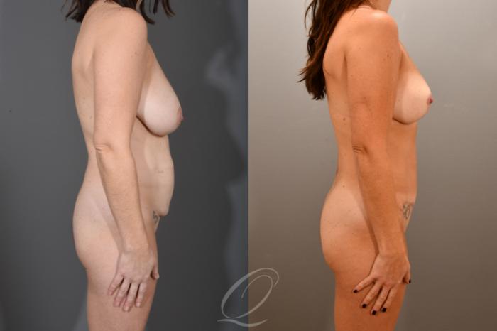 Tummy Tuck Case 1001722 Before & After Right Side | Serving Rochester, Syracuse & Buffalo, NY | Quatela Center for Plastic Surgery