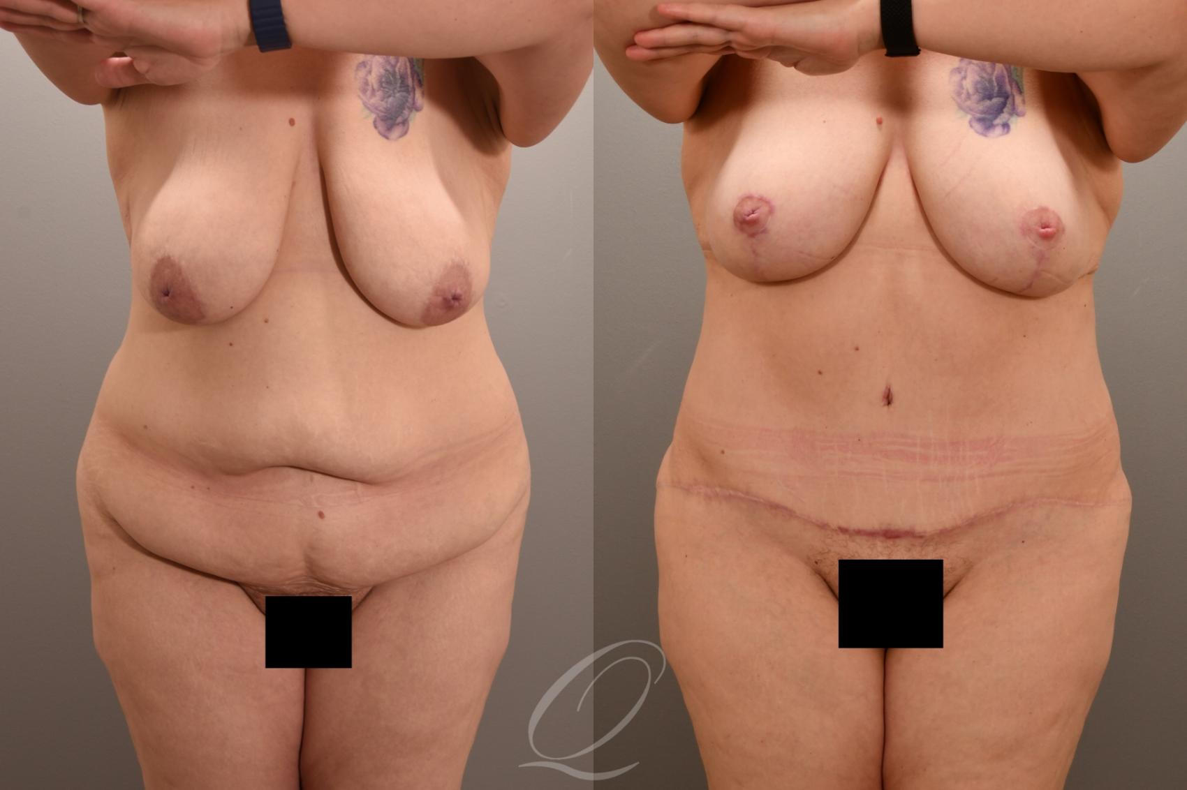 Mommy Makeover Case 1001723 Before & After Front | Serving Rochester, Syracuse & Buffalo, NY | Quatela Center for Plastic Surgery