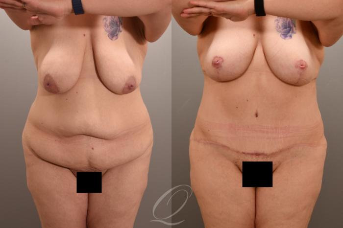 Tummy Tuck Case 1001723 Before & After Front | Serving Rochester, Syracuse & Buffalo, NY | Quatela Center for Plastic Surgery