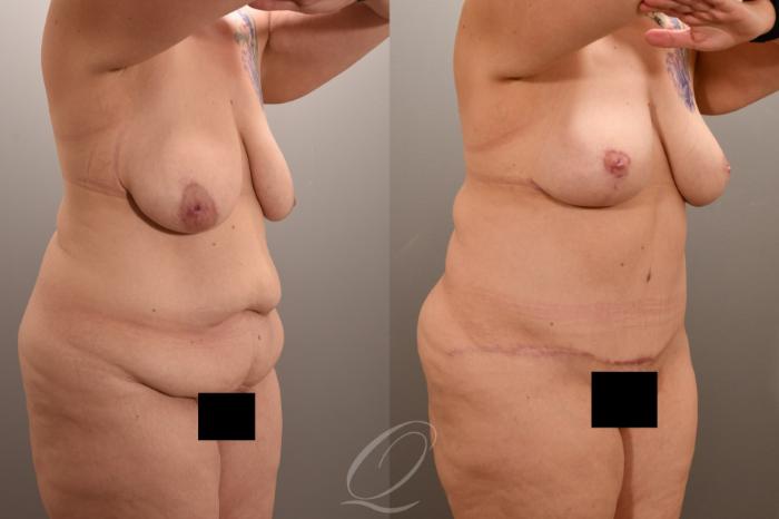 Tummy Tuck Case 1001723 Before & After Right Oblique | Serving Rochester, Syracuse & Buffalo, NY | Quatela Center for Plastic Surgery