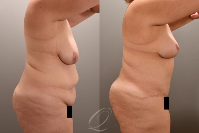 Breast Lift Case 1001723 Before & After Right Side | Serving Rochester, Syracuse & Buffalo, NY | Quatela Center for Plastic Surgery