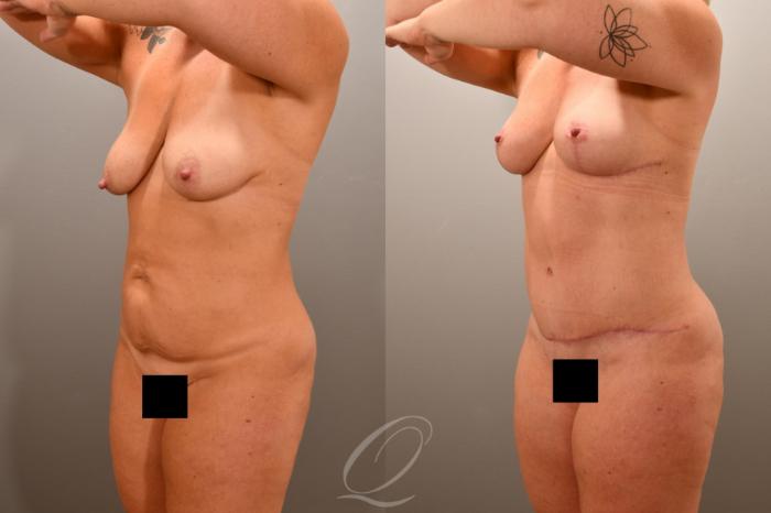 Mommy Makeover Case 1001786 Before & After Left Oblique | Serving Rochester, Syracuse & Buffalo, NY | Quatela Center for Plastic Surgery