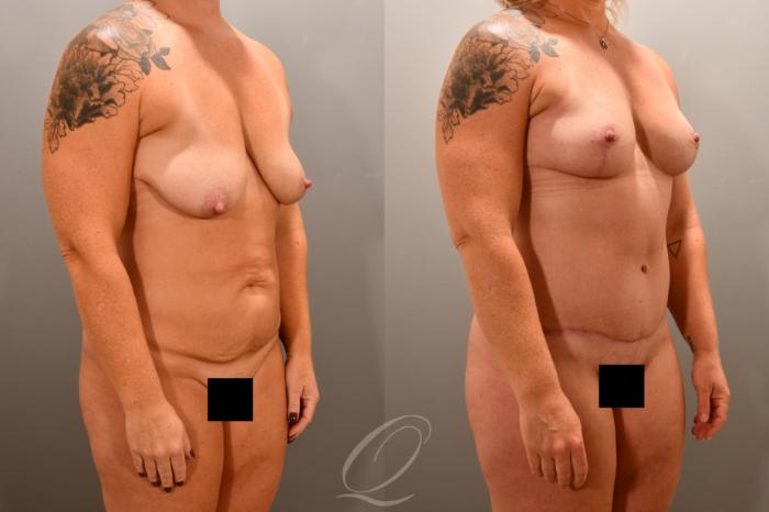 Mommy Makeover Case 1001786 Before & After Right Oblique | Serving Rochester, Syracuse & Buffalo, NY | Quatela Center for Plastic Surgery