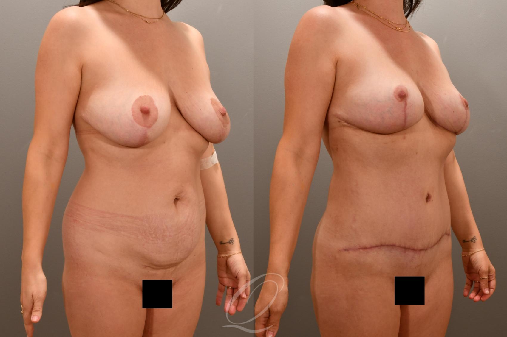 Liposuction Case 1001787 Before & After Right Oblique | Serving Rochester, Syracuse & Buffalo, NY | Quatela Center for Plastic Surgery