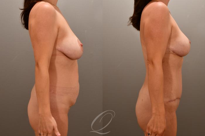 Mommy Makeover Case 1001787 Before & After Right Side | Serving Rochester, Syracuse & Buffalo, NY | Quatela Center for Plastic Surgery