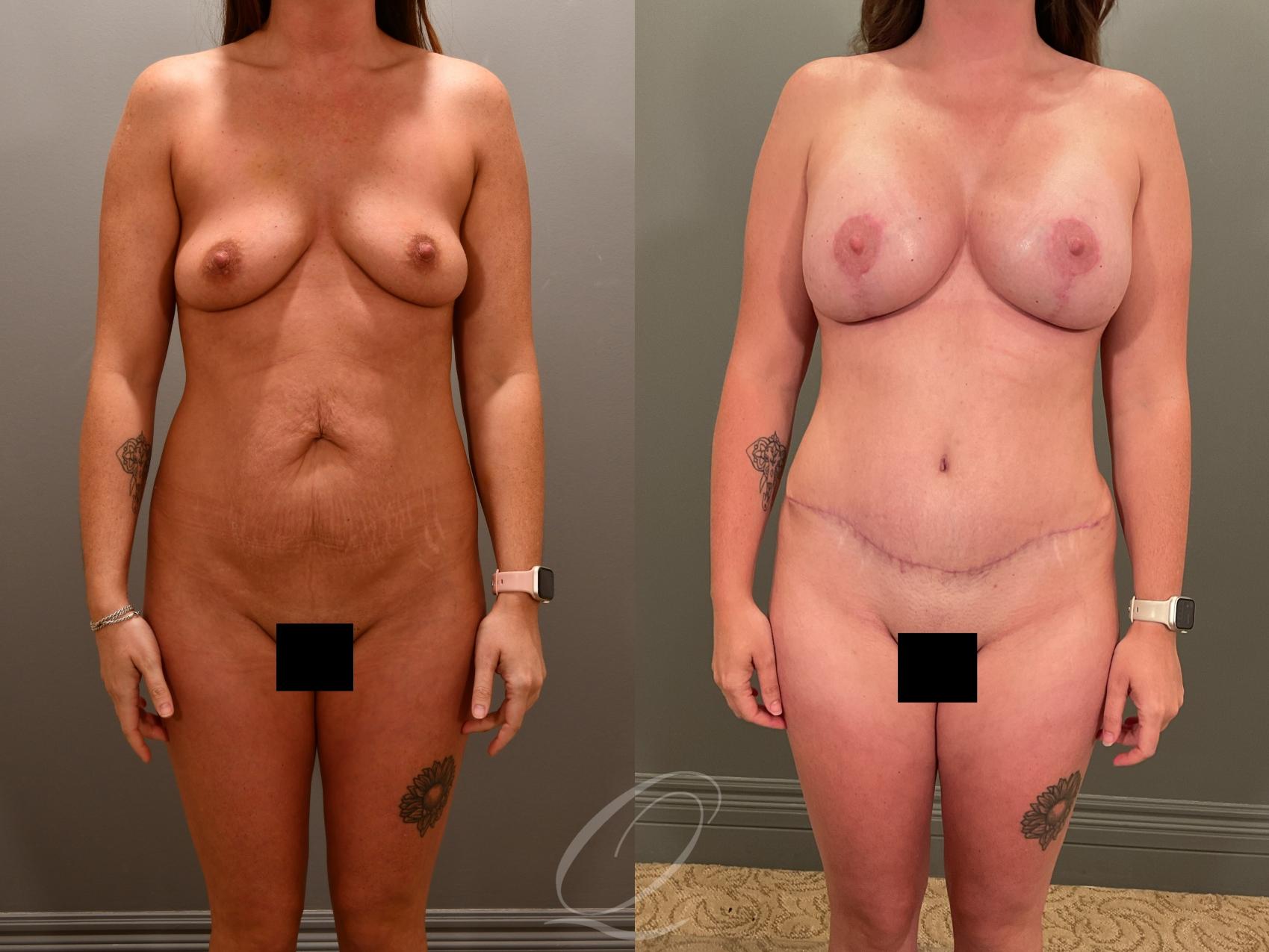 Breast Augmentation with Lift Case 1001898 Before & After Front | Serving Rochester, Syracuse & Buffalo, NY | Quatela Center for Plastic Surgery
