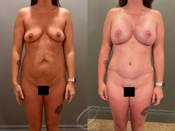 Breast Augmentation with Lift Case 1001898 Before & After Front | Serving Rochester, Syracuse & Buffalo, NY | Quatela Center for Plastic Surgery