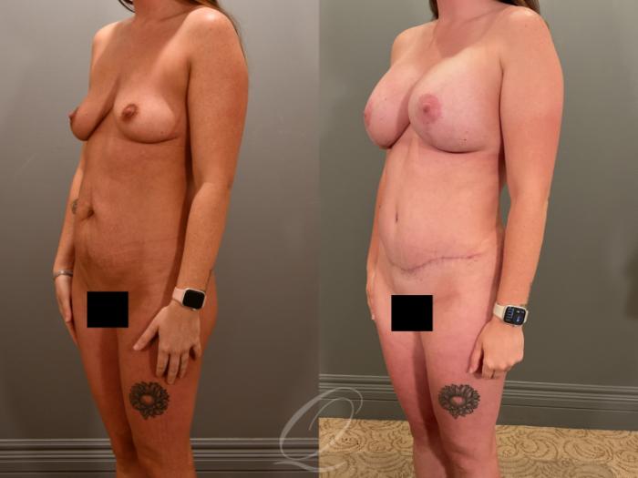 Breast Augmentation with Lift Case 1001898 Before & After Left Oblique | Serving Rochester, Syracuse & Buffalo, NY | Quatela Center for Plastic Surgery