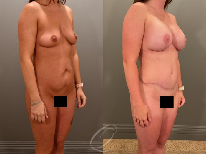Breast Augmentation with Lift Case 1001898 Before & After Right Oblique | Serving Rochester, Syracuse & Buffalo, NY | Quatela Center for Plastic Surgery