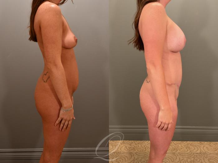 Breast Augmentation with Lift Case 1001898 Before & After Right Side | Serving Rochester, Syracuse & Buffalo, NY | Quatela Center for Plastic Surgery