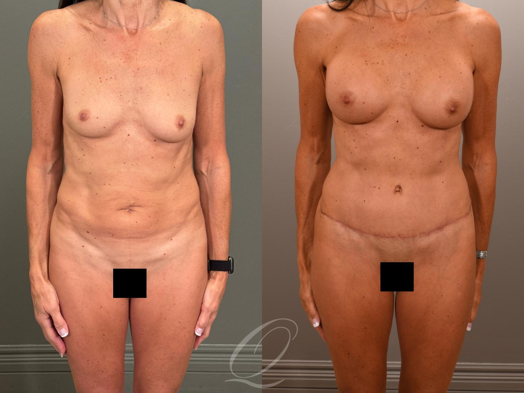 Breast Augmentation Case 1001899 Before & After Front | Serving Rochester, Syracuse & Buffalo, NY | Quatela Center for Plastic Surgery