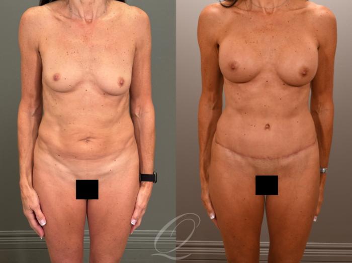 Breast Augmentation Case 1001899 Before & After Front | Serving Rochester, Syracuse & Buffalo, NY | Quatela Center for Plastic Surgery