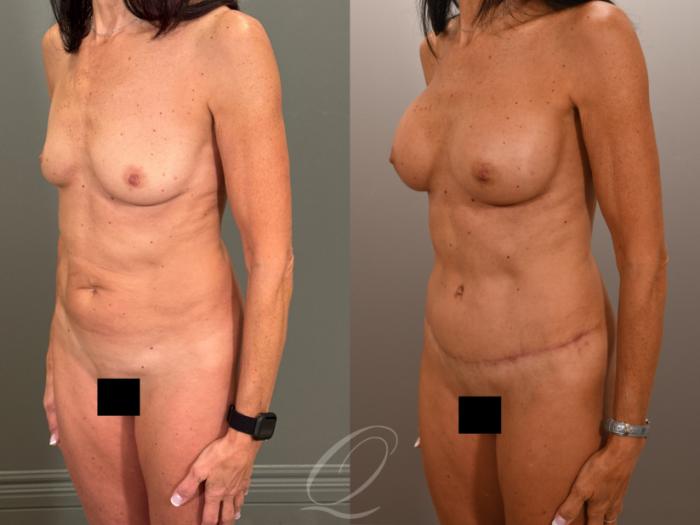 Breast Augmentation Case 1001899 Before & After Left Oblique | Serving Rochester, Syracuse & Buffalo, NY | Quatela Center for Plastic Surgery