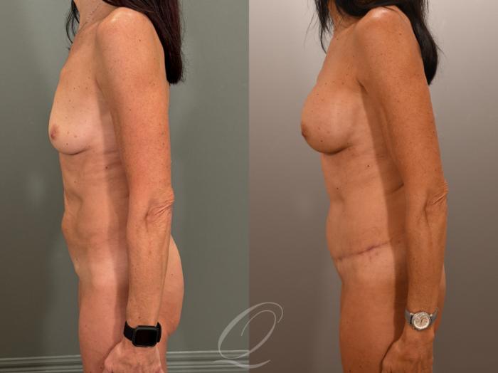 Breast Augmentation Case 1001899 Before & After Left Side | Serving Rochester, Syracuse & Buffalo, NY | Quatela Center for Plastic Surgery