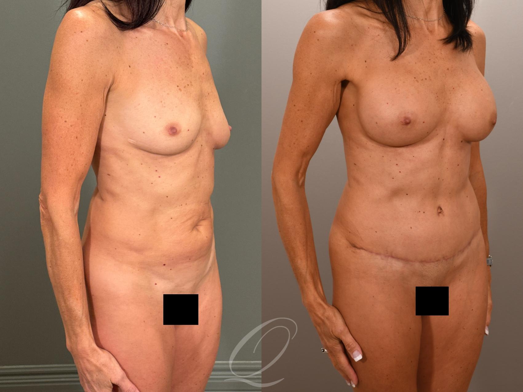 Breast Augmentation Case 1001899 Before & After Right Oblique | Serving Rochester, Syracuse & Buffalo, NY | Quatela Center for Plastic Surgery