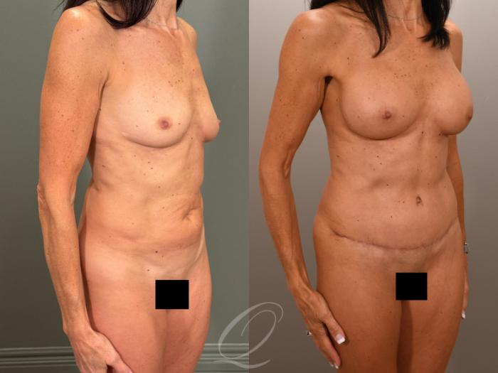 Breast Augmentation Case 1001899 Before & After Right Oblique | Serving Rochester, Syracuse & Buffalo, NY | Quatela Center for Plastic Surgery