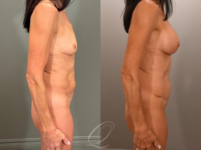 Breast Augmentation Case 1001899 Before & After Right Side | Serving Rochester, Syracuse & Buffalo, NY | Quatela Center for Plastic Surgery