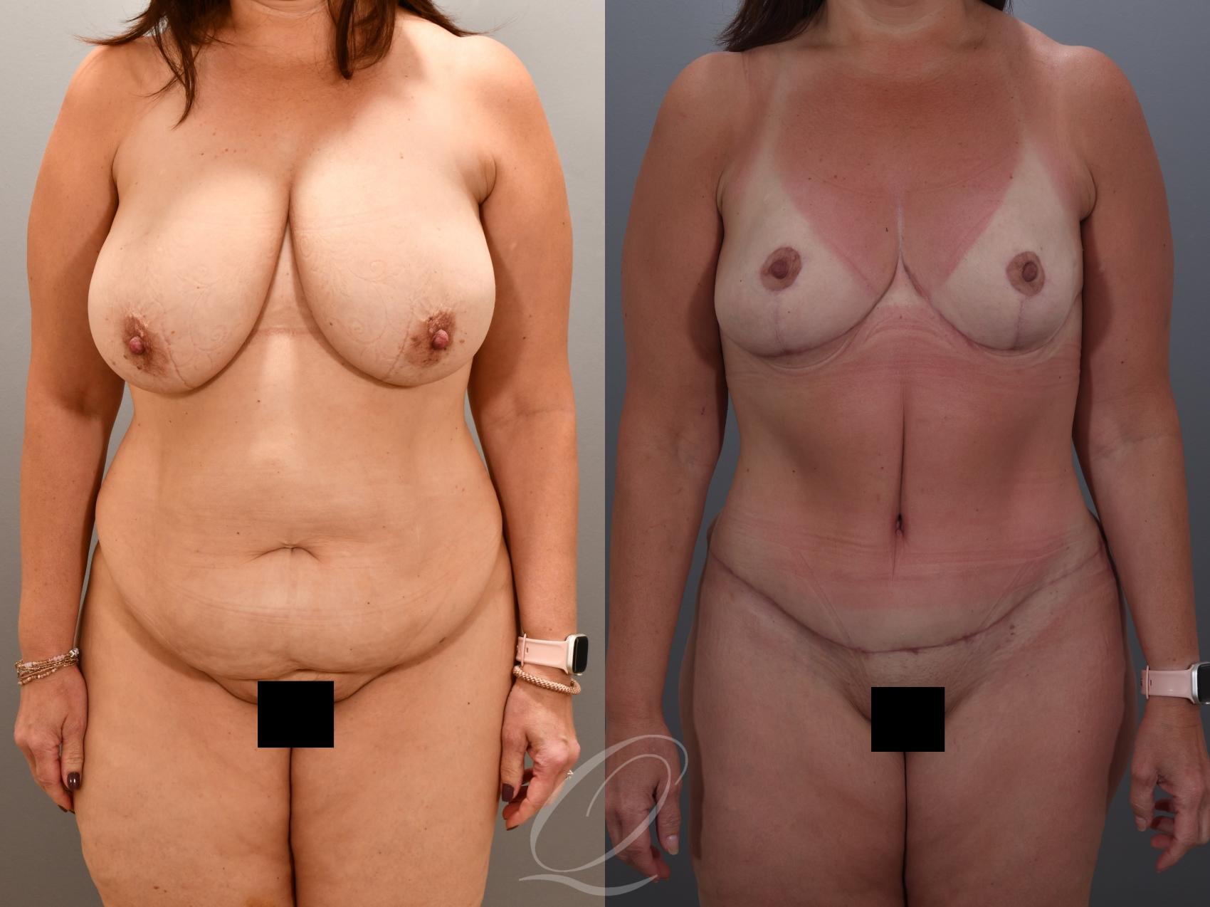 Mommy Makeover Case 1001900 Before & After Front | Serving Rochester, Syracuse & Buffalo, NY | Quatela Center for Plastic Surgery