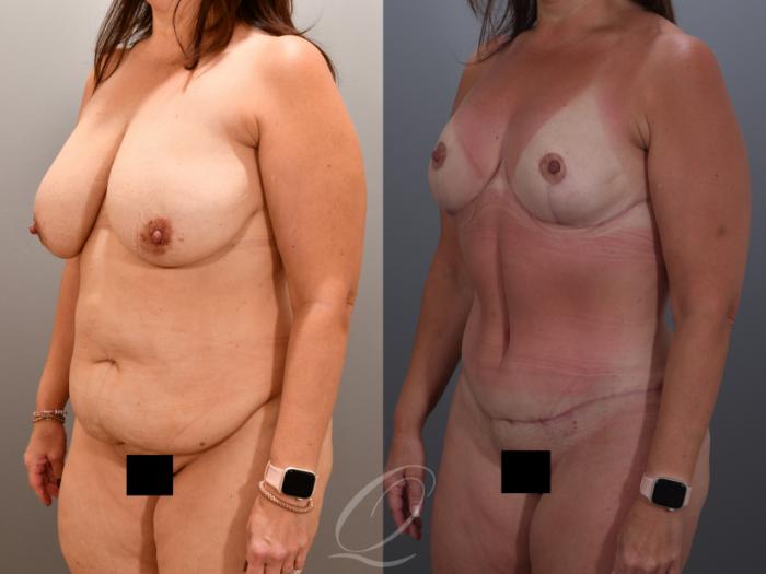 Mommy Makeover Case 1001900 Before & After Left Oblique | Serving Rochester, Syracuse & Buffalo, NY | Quatela Center for Plastic Surgery