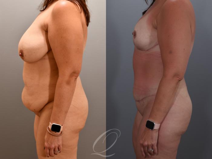 Mommy Makeover Case 1001900 Before & After Left Side | Serving Rochester, Syracuse & Buffalo, NY | Quatela Center for Plastic Surgery