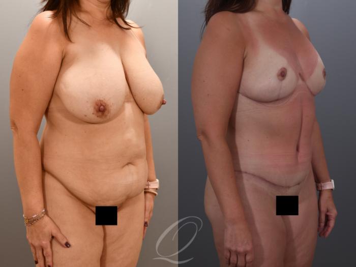 Mommy Makeover Case 1001900 Before & After Right Oblique | Serving Rochester, Syracuse & Buffalo, NY | Quatela Center for Plastic Surgery