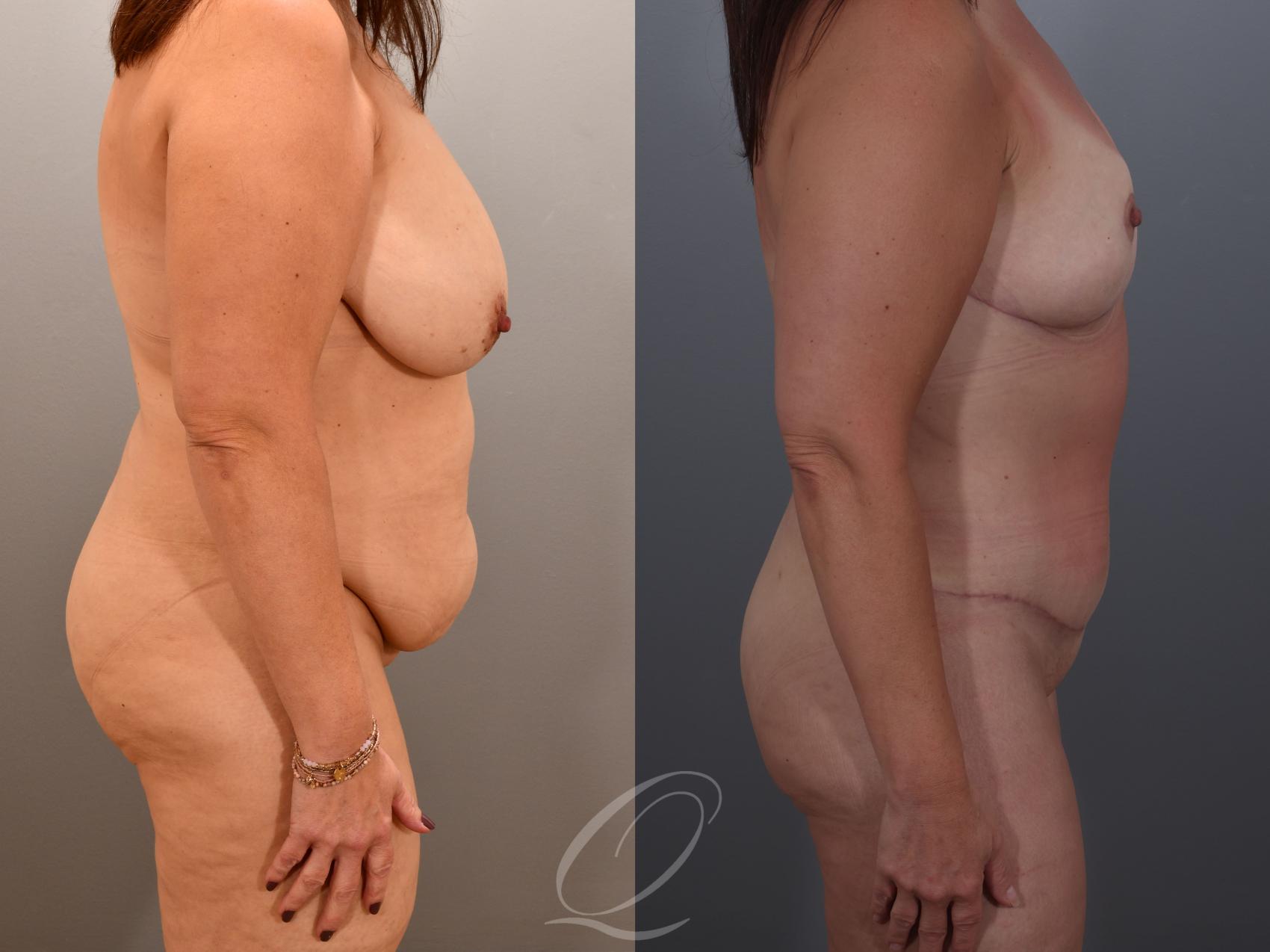 Mommy Makeover Case 1001900 Before & After Right Side | Serving Rochester, Syracuse & Buffalo, NY | Quatela Center for Plastic Surgery