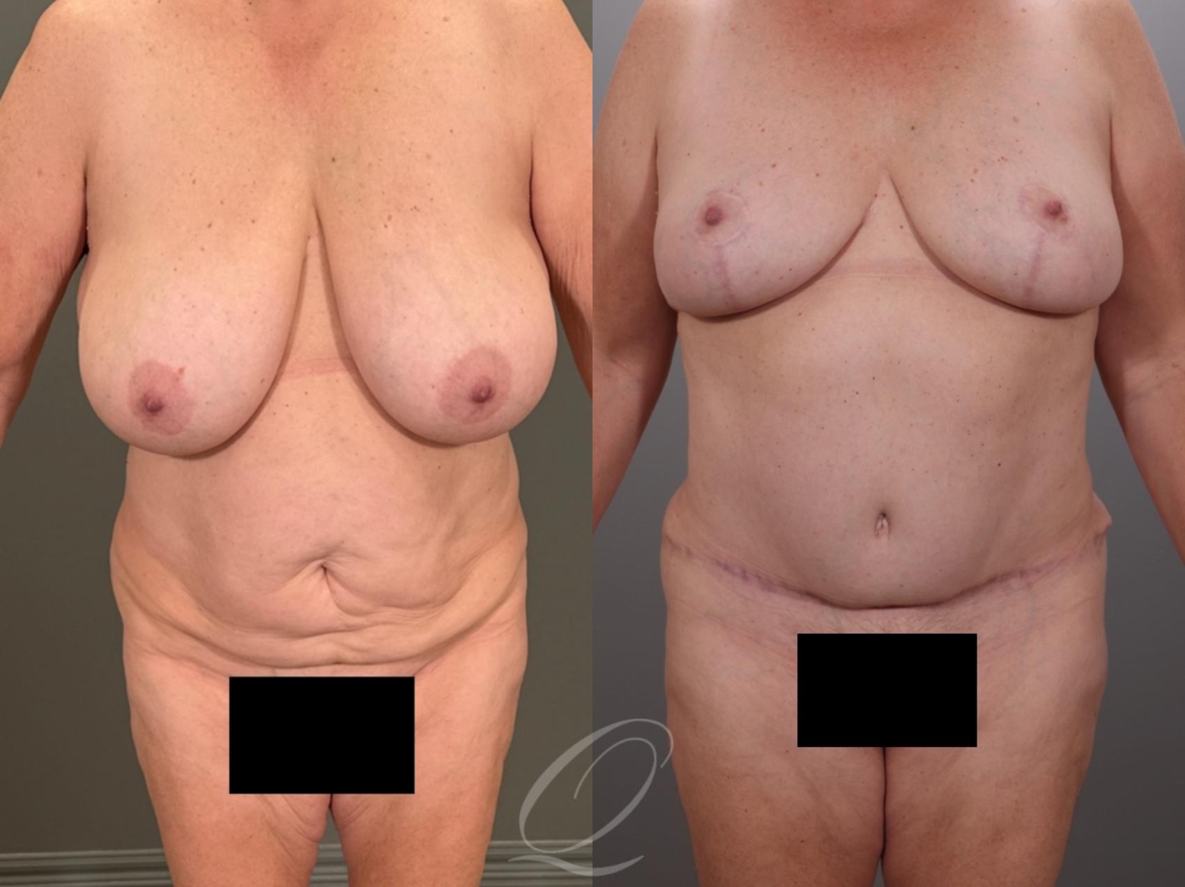 Mommy Makeover Case 1001937 Before & After Front | Serving Rochester, Syracuse & Buffalo, NY | Quatela Center for Plastic Surgery