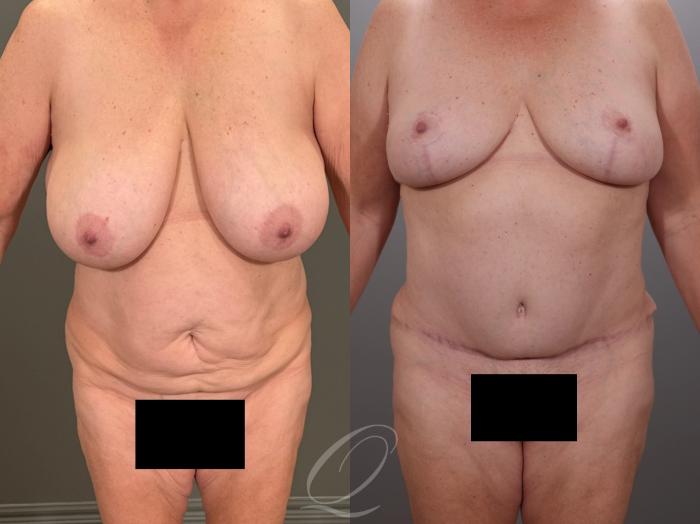 Mommy Makeover Case 1001937 Before & After Front | Serving Rochester, Syracuse & Buffalo, NY | Quatela Center for Plastic Surgery