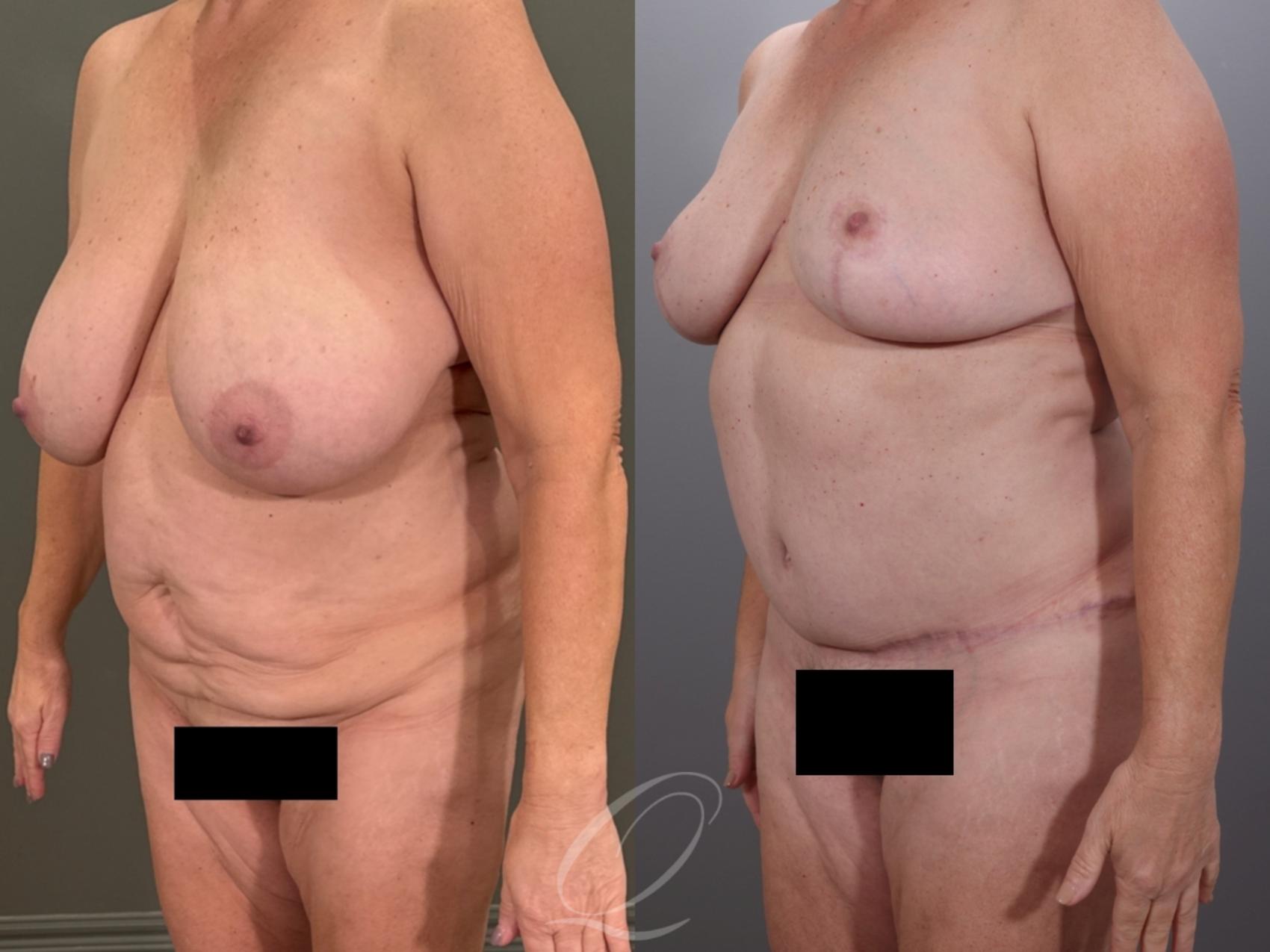 Mommy Makeover Case 1001937 Before & After Left Oblique | Serving Rochester, Syracuse & Buffalo, NY | Quatela Center for Plastic Surgery