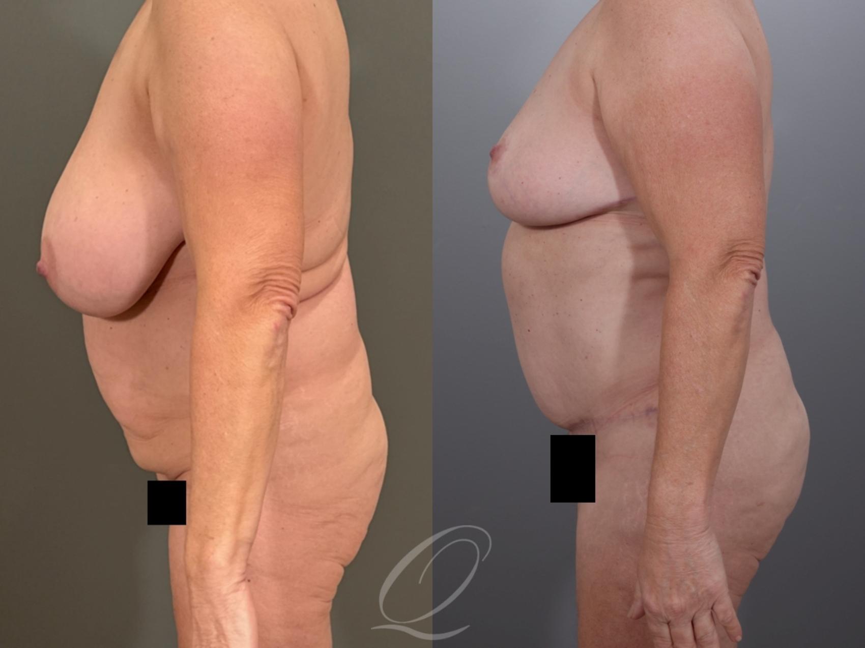 Mommy Makeover Case 1001937 Before & After Left Side | Serving Rochester, Syracuse & Buffalo, NY | Quatela Center for Plastic Surgery