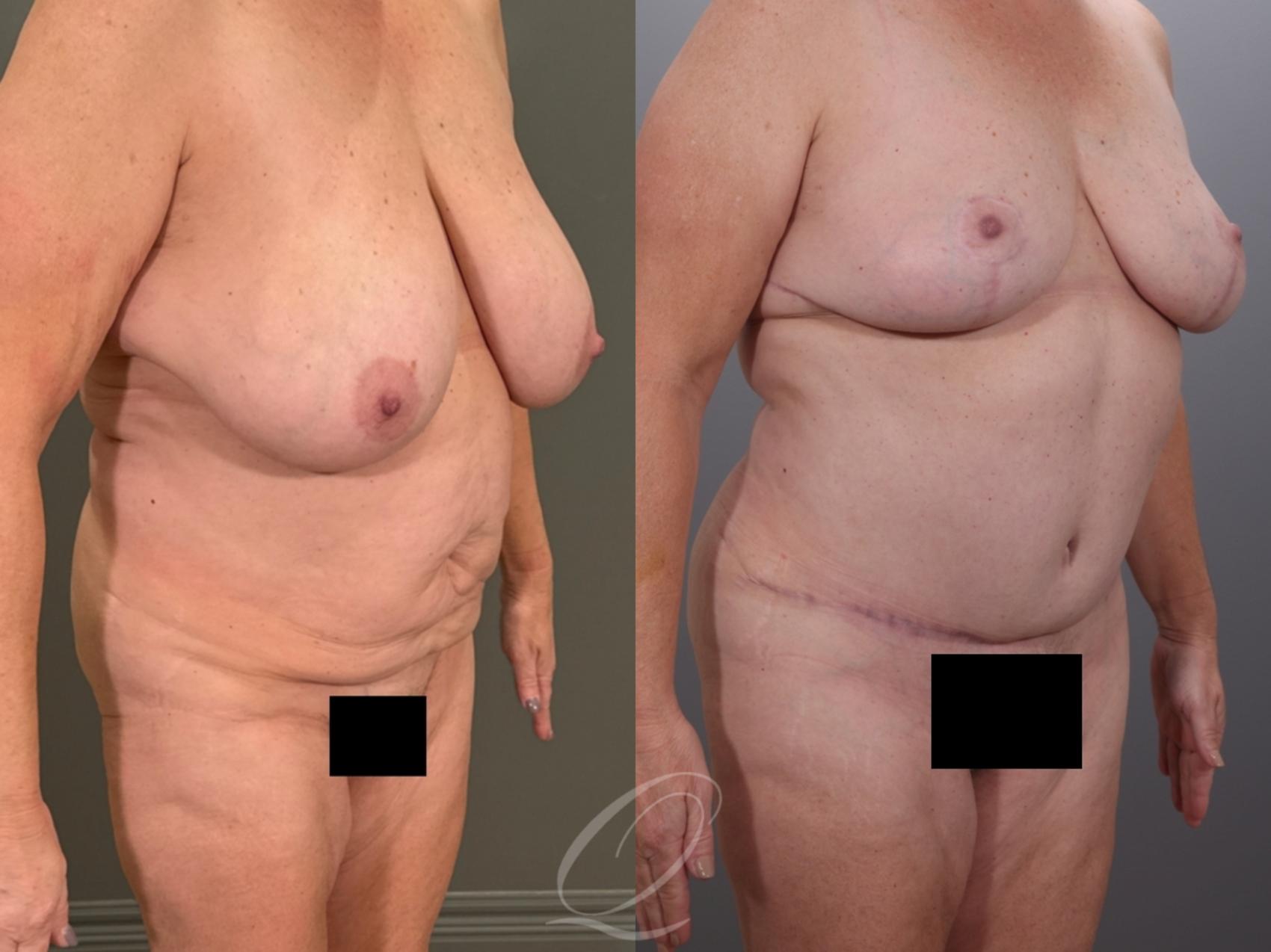 Mommy Makeover Case 1001937 Before & After Right Oblique | Serving Rochester, Syracuse & Buffalo, NY | Quatela Center for Plastic Surgery