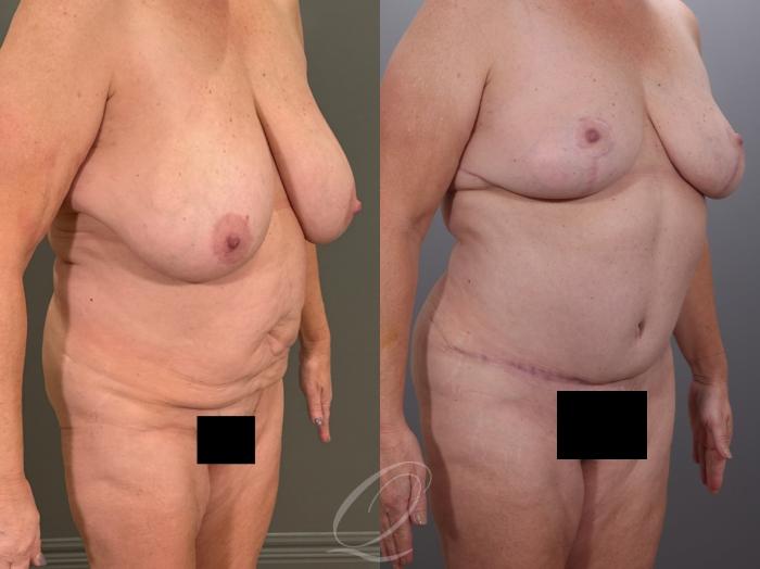 Mommy Makeover Case 1001937 Before & After Right Oblique | Serving Rochester, Syracuse & Buffalo, NY | Quatela Center for Plastic Surgery