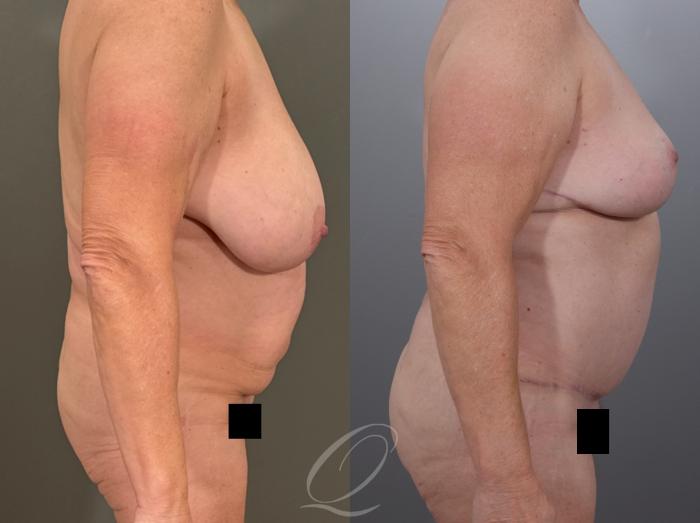 Mommy Makeover Case 1001937 Before & After Right Side | Serving Rochester, Syracuse & Buffalo, NY | Quatela Center for Plastic Surgery