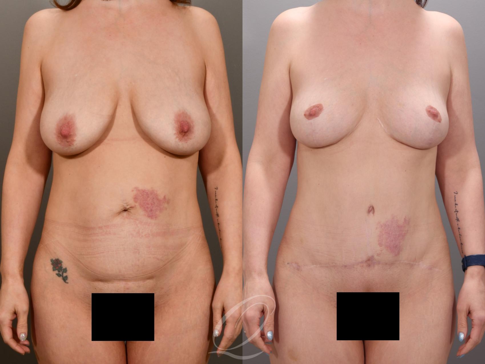 Mommy Makeover Case 1001973 Before & After Front | Serving Rochester, Syracuse & Buffalo, NY | Quatela Center for Plastic Surgery