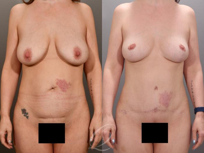 Mommy Makeover Case 1001973 Before & After Front | Serving Rochester, Syracuse & Buffalo, NY | Quatela Center for Plastic Surgery