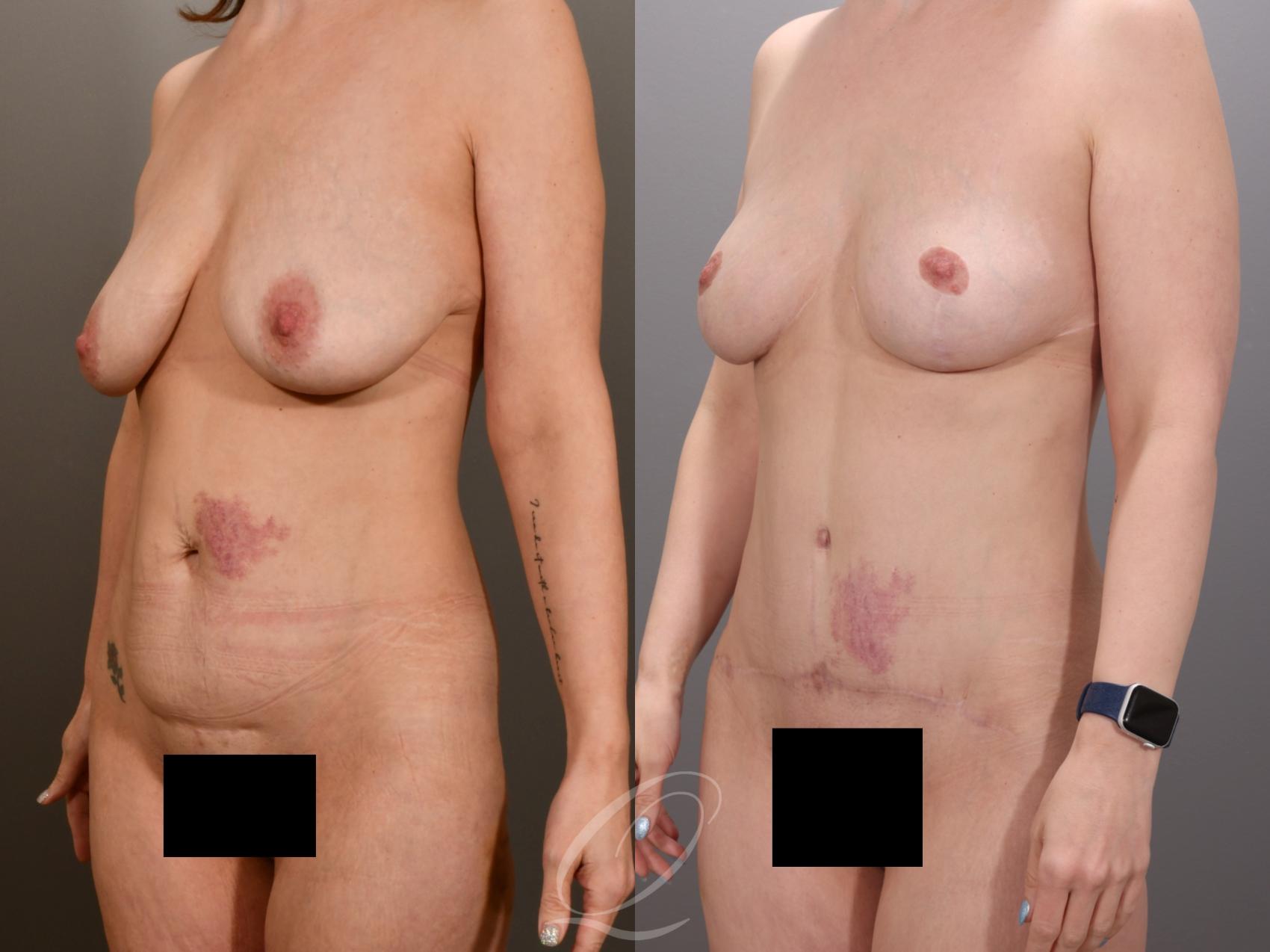 Mommy Makeover Case 1001973 Before & After Left Oblique | Serving Rochester, Syracuse & Buffalo, NY | Quatela Center for Plastic Surgery