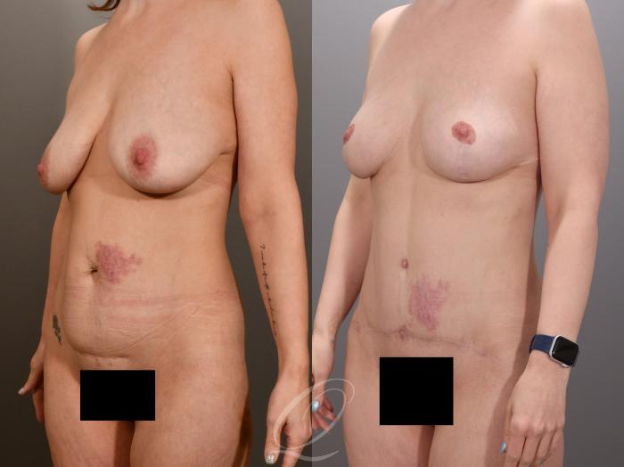 Mommy Makeover Case 1001973 Before & After Left Oblique | Serving Rochester, Syracuse & Buffalo, NY | Quatela Center for Plastic Surgery