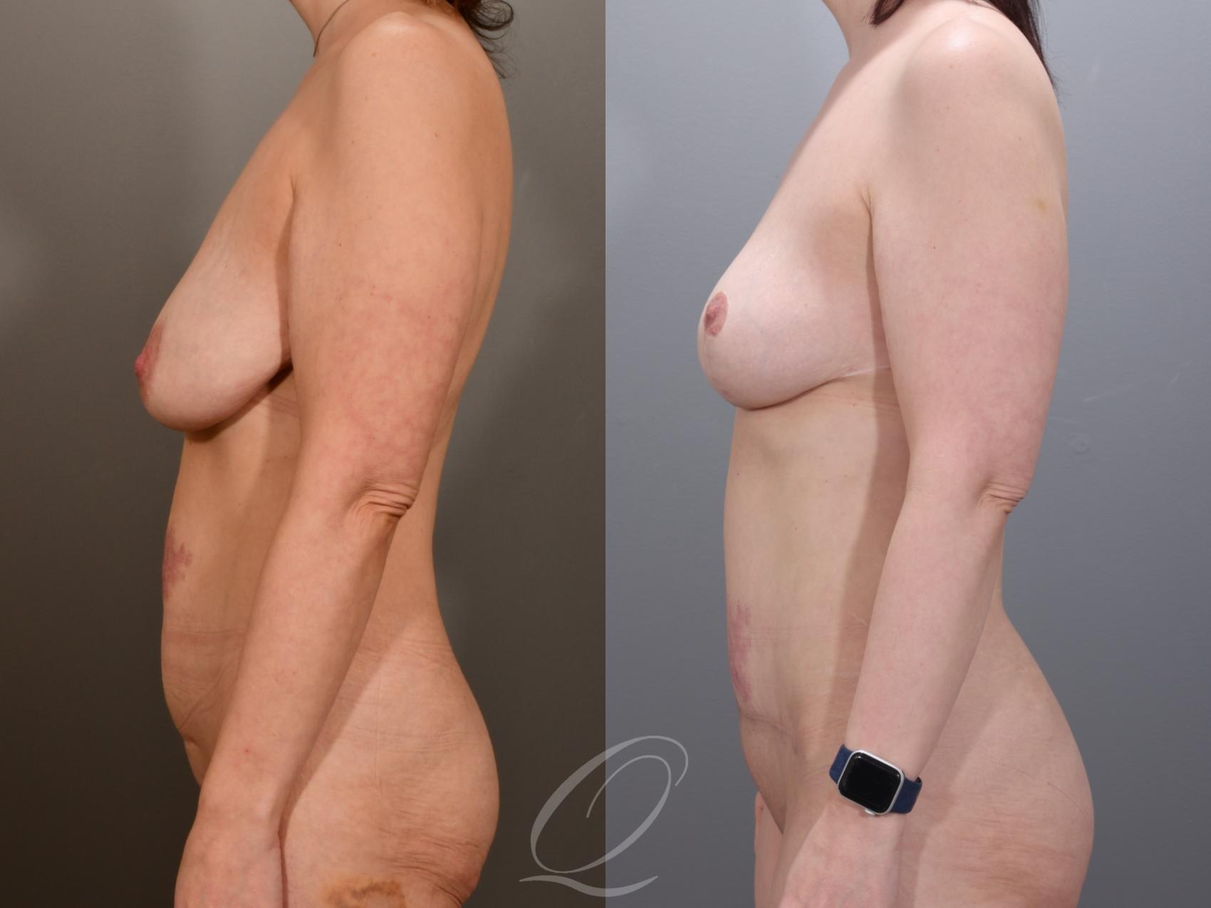 Mommy Makeover Case 1001973 Before & After Left Side | Serving Rochester, Syracuse & Buffalo, NY | Quatela Center for Plastic Surgery