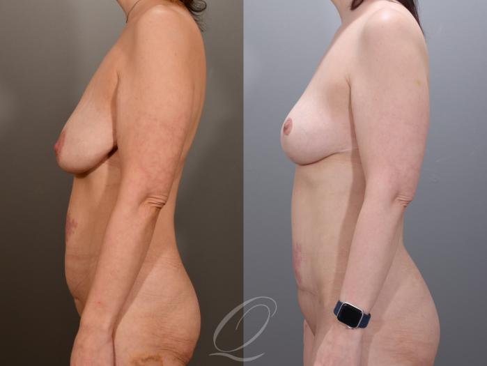 Mommy Makeover Case 1001973 Before & After Left Side | Serving Rochester, Syracuse & Buffalo, NY | Quatela Center for Plastic Surgery